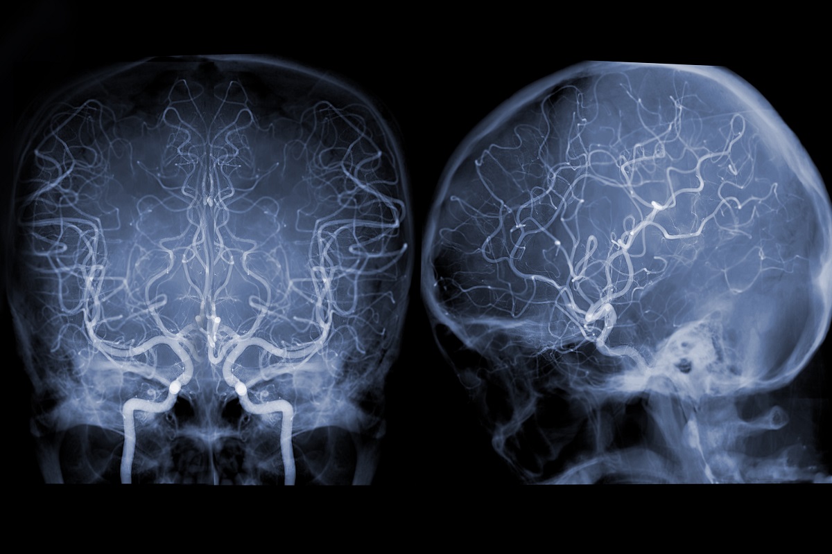 Cerebral angiography  image from Fluoroscopy in intervention radiology  showing cerebral artery.