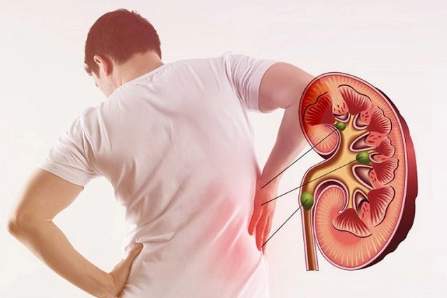 Warning Signs of Kidney Stones