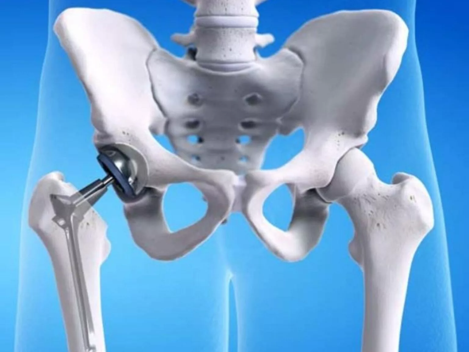 Hip Replacement Surgery Cost in India