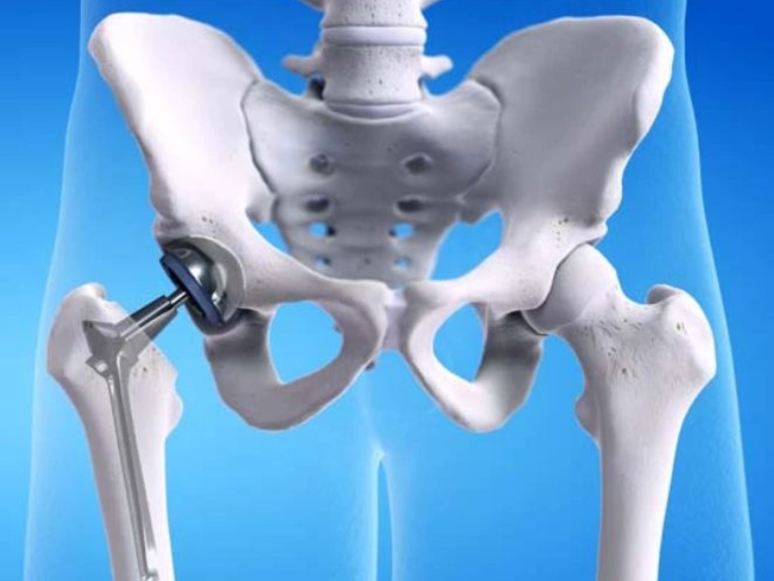 Hip Replacement Surgery Cost in India