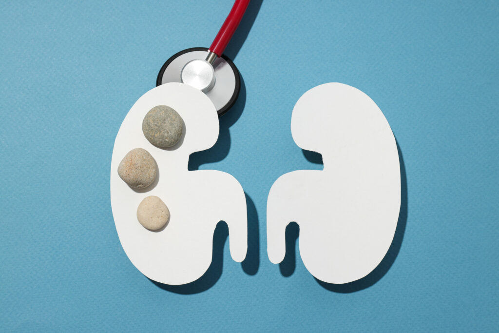 Kidney Stones in Toilet || Numed hospital