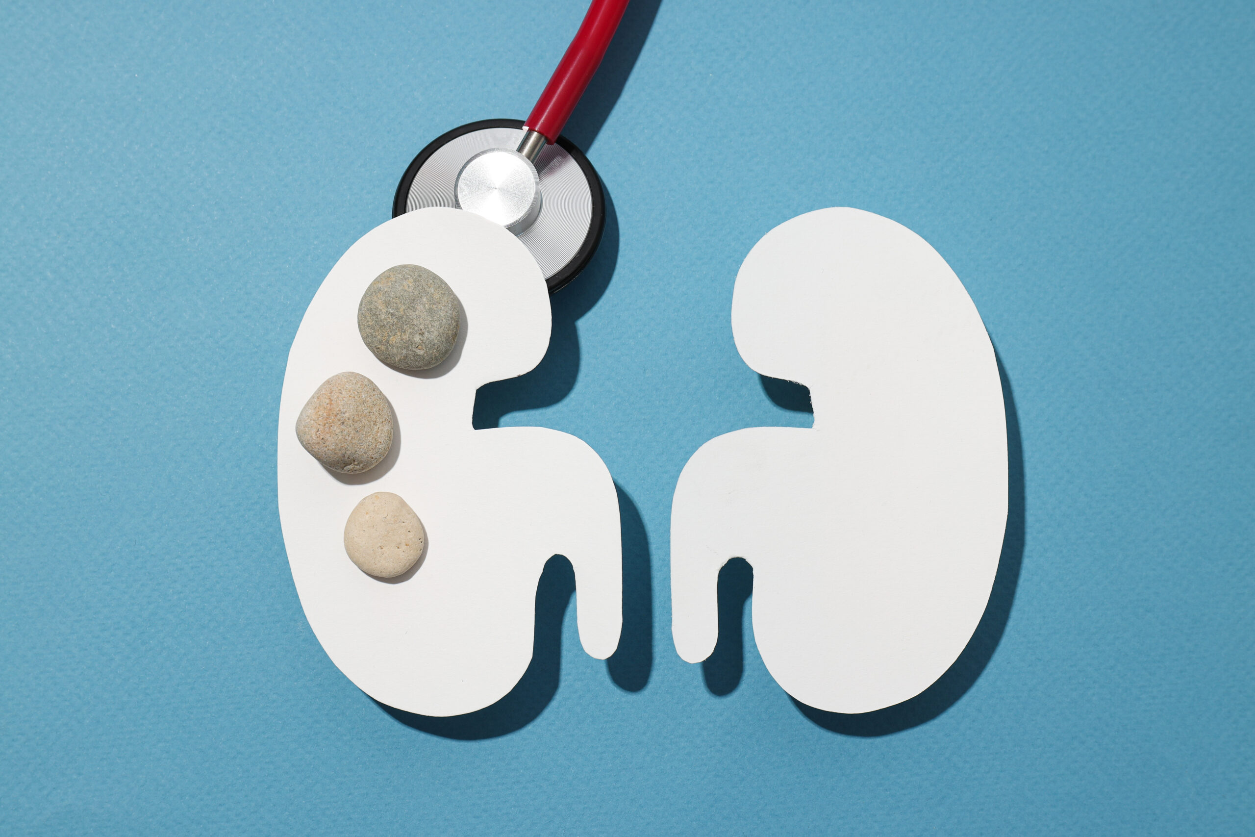 Kidney Stones in Toilet || Numed hospital