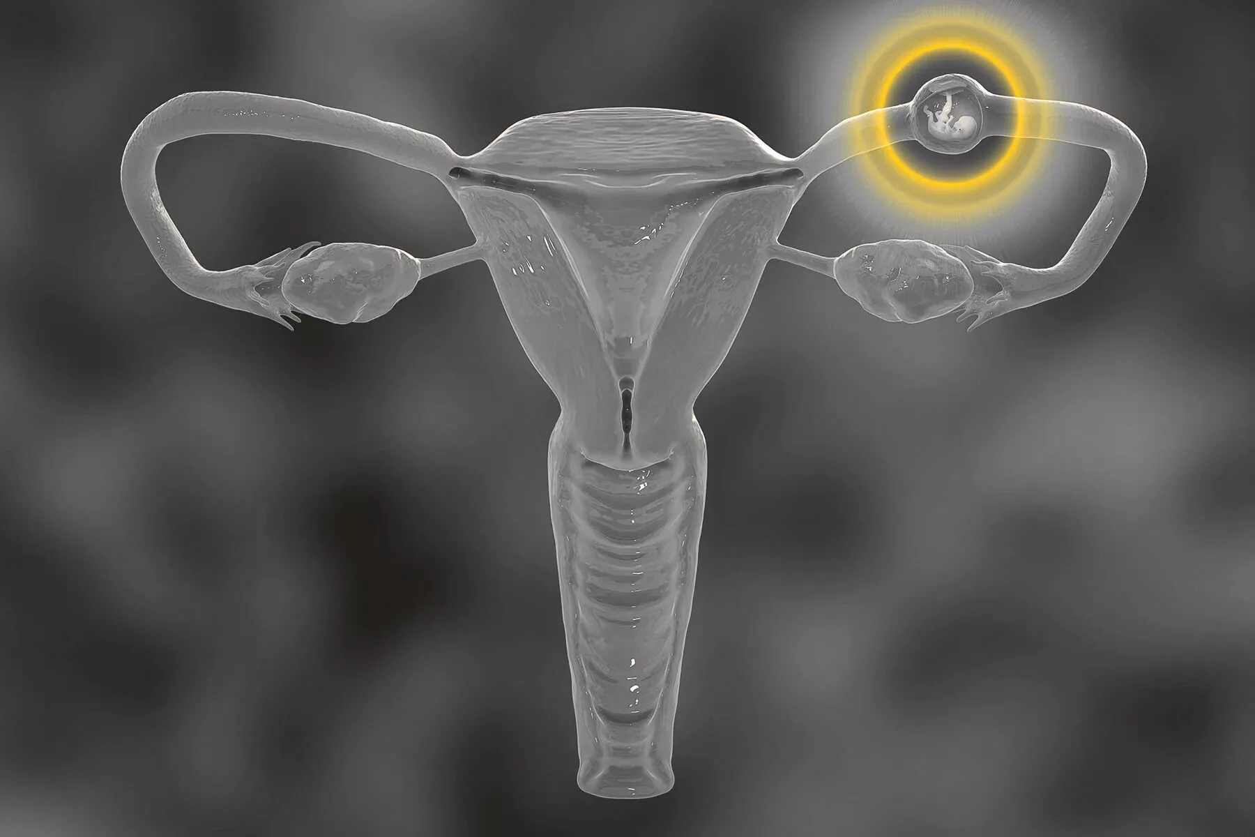 Ruptured Ectopic Pregnancy