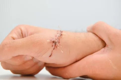 Deep Split Laceration