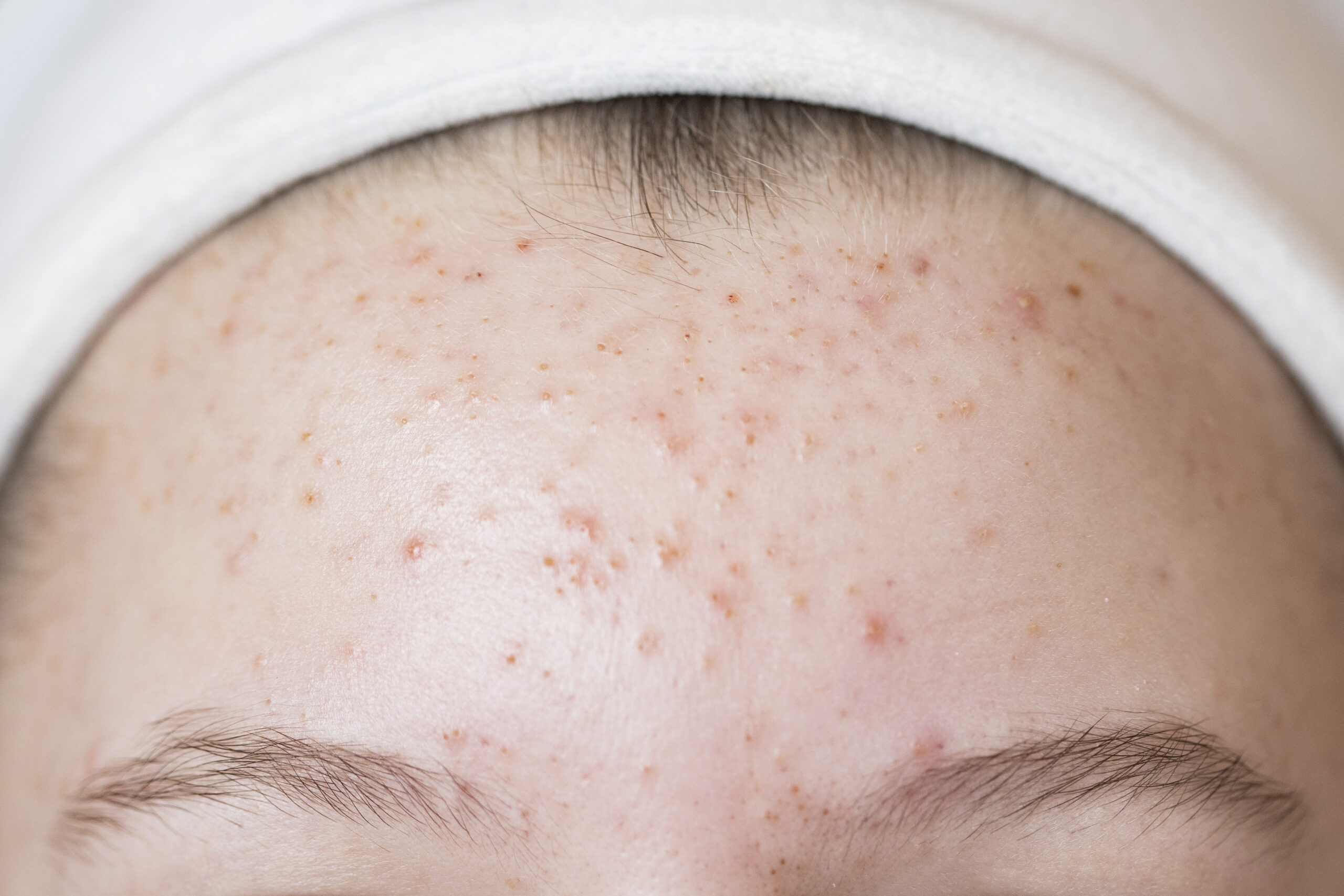 Forehead Pimples Reason
